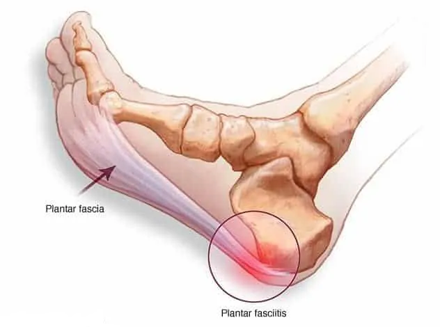 fasceíte plantar fasciíte plantar fascite plantar