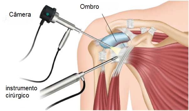 imagem esquemática mostrando o ombro e posicionamento d einstrumentos cirúrgico