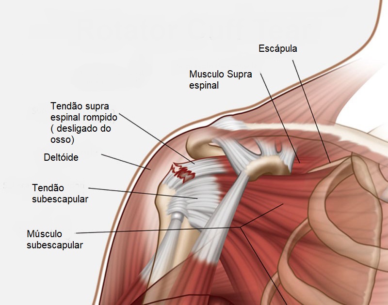 imagem esquemática mostrando o tendao rompido dento do ombro
