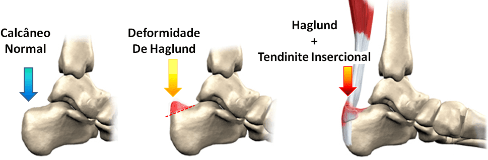 "Ilustração do pé humano mostrando a deformidade óssea associada à Síndrome de Haglund."